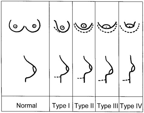 Tuberous breasts